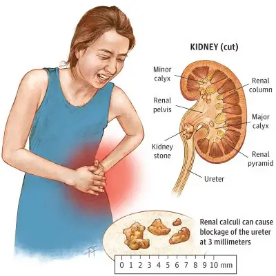 Kidney Stones - NIDDK