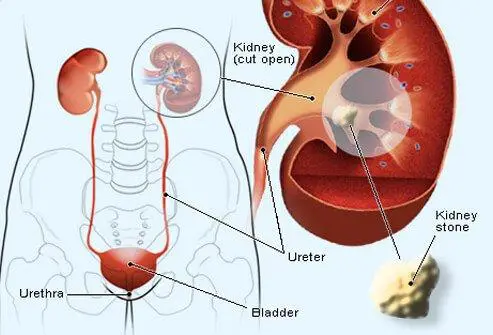 Kidney Stones - NIDDK