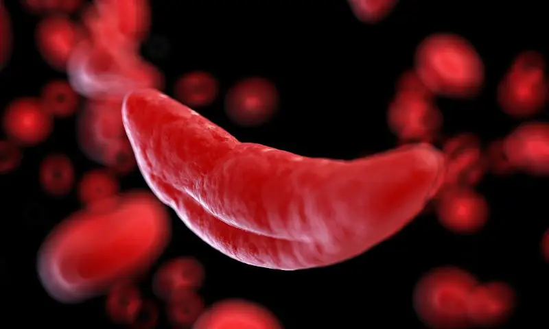 Battling Bent Blood Cells Progress in Sickle Cell Disease